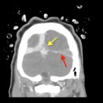 Computed Tomography Findings of Cerebral Venous Thrombosis: A Case Report 5 Cerebral Venous Thrombosis. CT Coronal Annotated. JETem 2026