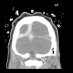 Computed Tomography Findings of Cerebral Venous Thrombosis: A Case Report 2 Cerebral Venous Thrombosis. CT Coronal Unannotated. JETem 2026