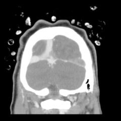 Computed Tomography Findings of Cerebral Venous Thrombosis: A Case Report 22 Cerebral Venous Thrombosis. CT Coronal Unannotated. JETem 2026
