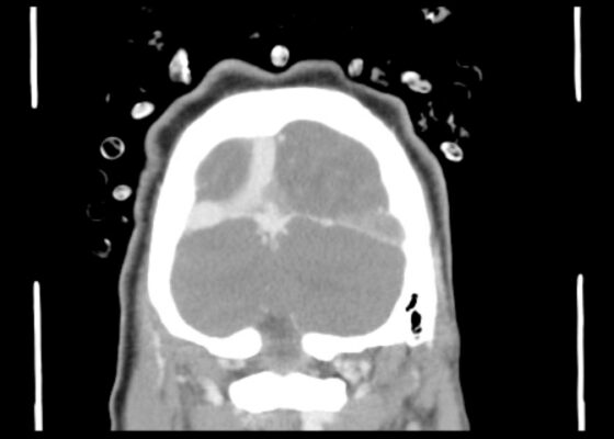 Computed Tomography Findings of Cerebral Venous Thrombosis: A Case Report 6 Cerebral Venous Thrombosis. CT Coronal Unannotated. JETem 2026