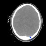 Computed Tomography Findings of Cerebral Venous Thrombosis: A Case Report 4 Cerebral Venous Thrombosis. CT Non Contrast Axial Annotated. JETem 2026