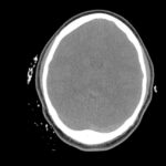 Computed Tomography Findings of Cerebral Venous Thrombosis: A Case Report 1 Cerebral Venous Thrombosis. CT Non Contrast Axial Unannotated. JETem 2026