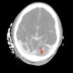 Computed Tomography Findings of Cerebral Venous Thrombosis: A Case Report 6 Cerebral Venous Thrombosis. CTA Axial Annotated. JETem 2026