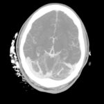 Computed Tomography Findings of Cerebral Venous Thrombosis: A Case Report 3 Cerebral Venous Thrombosis. CTA Axial Unannotated. JETem 2026