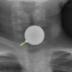 Coin Stack. Neck XR AP Annotated. JETem 2026