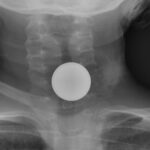 Coin Stack. Neck XR AP Unannotated. JETem 2026