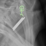 Coin Stack. Neck XR Lateral Annotated. JETem 2026