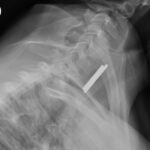 Coin Stack. Neck XR Lateral Unannotated. JETem 2026