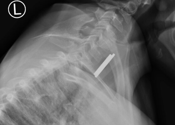 A Case Report of a Coin Stack Masquerading as a Button Battery 12 Coin Stack. Neck XR Lateral Unannotated. JETem 2026