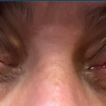 A Case Report of Granulomatosis with Polyangiitis Presenting with Chronic Conjunctivitis 1 Granulomatosis with Polyangiitis. Chonic Conjunctivitis. JETem 2026