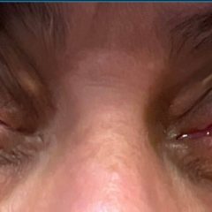 A Case Report of Granulomatosis with Polyangiitis Presenting with Chronic Conjunctivitis 11 Granulomatosis with Polyangiitis. Chonic Conjunctivitis. JETem 2026