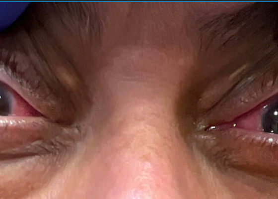 A Case Report of Granulomatosis with Polyangiitis Presenting with Chronic Conjunctivitis 6 Granulomatosis with Polyangiitis. Chonic Conjunctivitis. JETem 2026
