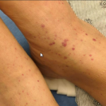 A Case Report of Granulomatosis with Polyangiitis Presenting with Chronic Conjunctivitis 2 Granulomatosis with Polyangiitis. Lower Extremity. JETem 2026