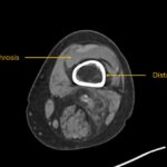 Hematoma, Hemarthrosis, and Hemotympanum: A Case Report of Acquired Hemophilia A 3 Hematoma Hemarthrosis and Hemotympanum. CT Knee Distal Femur Annotated