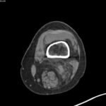 Hematoma, Hemarthrosis, and Hemotympanum: A Case Report of Acquired Hemophilia A 1 Hematoma Hemarthrosis and Hemotympanum. CT Knee Distal Femur. JETem 2026