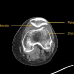 Hematoma, Hemarthrosis, and Hemotympanum: A Case Report of Acquired Hemophilia A 4 Hematoma Hemarthrosis and Hemotympanum. CT Knee Patella Annotated. JETem 2026