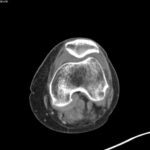 Hematoma, Hemarthrosis, and Hemotympanum: A Case Report of Acquired Hemophilia A 2 Hematoma Hemarthrosis and Hemotympanum. CT Knee Patella. JETem 2026