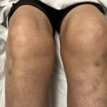 Hematoma, Hemarthrosis, and Hemotympanum: A Case Report of Acquired Hemophilia A 5 Hematoma Hemarthrosis and Hemotympanum. Hemarthrosis Photo. JETem 2026