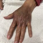 Hematoma, Hemarthrosis, and Hemotympanum: A Case Report of Acquired Hemophilia A 6 Hematoma Hemarthrosis and Hemotympanum. Hematoma Dorsal Hand. JETem 2026