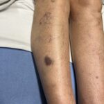 Hematoma, Hemarthrosis, and Hemotympanum: A Case Report of Acquired Hemophilia A 7 Hematoma Hemarthrosis and Hemotympanum. Hematoma Lower Leg. JETem 2026