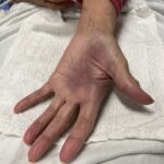 Hematoma, Hemarthrosis, and Hemotympanum: A Case Report of Acquired Hemophilia A 8 Hematoma Hemarthrosis and Hemotympanum. Hematoma Palmar Hand. JETem 2026