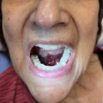 Hematoma, Hemarthrosis, and Hemotympanum: A Case Report of Acquired Hemophilia A 9 Hematoma Hemarthrosis and Hemotympanum. Sublingual Hematoma. JETem 2026