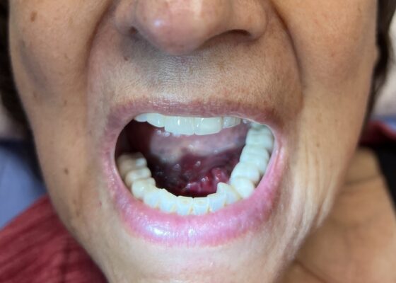 Hematoma, Hemarthrosis, and Hemotympanum: A Case Report of Acquired Hemophilia A 10 Hematoma Hemarthrosis and Hemotympanum. Sublingual Hematoma. JETem 2026