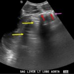 A-Lines below the Diaphragm – A Case Report of Occult Pneumoperitoneum 5 Occult Pneumoperitoneum. Figure 1 Annotated. JETem 2026