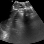 A-Lines below the Diaphragm – A Case Report of Occult Pneumoperitoneum 1 Occult Pneumoperitoneum. Figure 1 Unannotated. JETem 2026