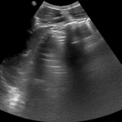 A-Lines below the Diaphragm – A Case Report of Occult Pneumoperitoneum 5 Occult Pneumoperitoneum. Figure 1 Unannotated. JETem 2026