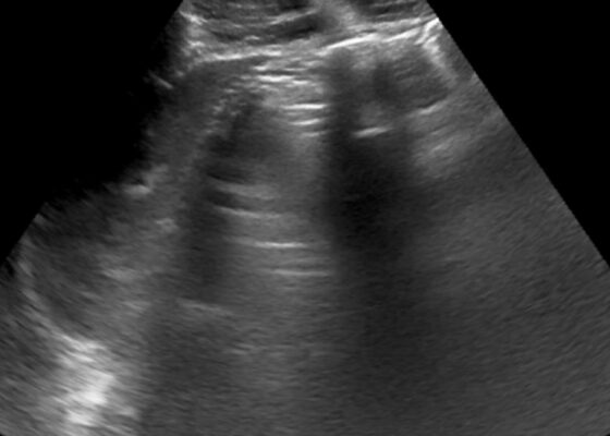A-Lines below the Diaphragm – A Case Report of Occult Pneumoperitoneum 4 Occult Pneumoperitoneum. Figure 1 Unannotated. JETem 2026