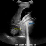 A-Lines below the Diaphragm – A Case Report of Occult Pneumoperitoneum 6 Occult Pneumoperitoneum. Figure 2 Annotated. JETem 2026 1
