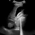 A-Lines below the Diaphragm – A Case Report of Occult Pneumoperitoneum 2 Occult Pneumoperitoneum. Figure 2 Unannotated. JETem 2026
