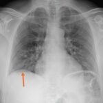 A-Lines below the Diaphragm – A Case Report of Occult Pneumoperitoneum 7 Occult Pneumoperitoneum. Figure 3 Annotated. JETem 2026