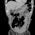A-Lines below the Diaphragm – A Case Report of Occult Pneumoperitoneum 4 Occult Pneumoperitoneum. Figure 3 Unannotated. JETem 2026