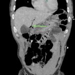 A-Lines below the Diaphragm – A Case Report of Occult Pneumoperitoneum 8 Occult Pneumoperitoneum. Figure 4 Annotated. JETem 2026