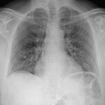 A-Lines below the Diaphragm – A Case Report of Occult Pneumoperitoneum 3 Occult Pneumoperitoneum. Figure 4 Unannotated. JETem 2026
