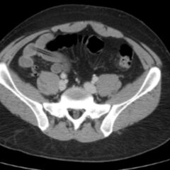 Intentional Pencil Ingestion. CT axial. JETem 2026