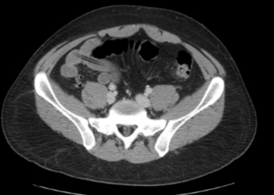 Intentional Pencil Ingestion. CT axial. JETem 2026