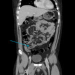 Intentional Pencil Ingestion – A Case Report of a Sharp Ingested Foreign Body 6 Intentional Pencil Ingestion. CT coronal annotated. JETem 2026