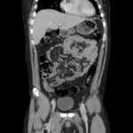 Intentional Pencil Ingestion – A Case Report of a Sharp Ingested Foreign Body 3 Intentional Pencil Ingestion. CT coronal. JETem 2026