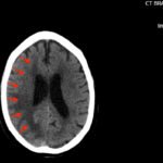 ARIA. CT Axial Annotated. JETem 2026