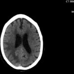 ARIA. CT Axial. JETem 2026