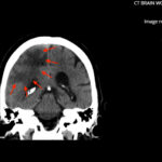 ARIA. CT Coronal Annotated. JETem 2026
