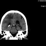 ARIA. CT Coronal. JETem 2026
