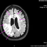 ARIA. MRI Axial Annotated. JETem 2026