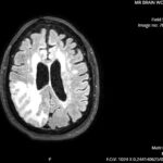 ARIA. MRI Axial. JETem 2026