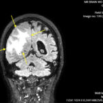 ARIA. MRI Coronal Annotated. JETem 2026