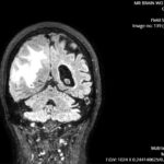 ARIA. MRI Coronal. JETem 2026