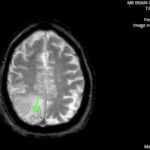 ARIA. T2 Flair Axial 1 Annotated